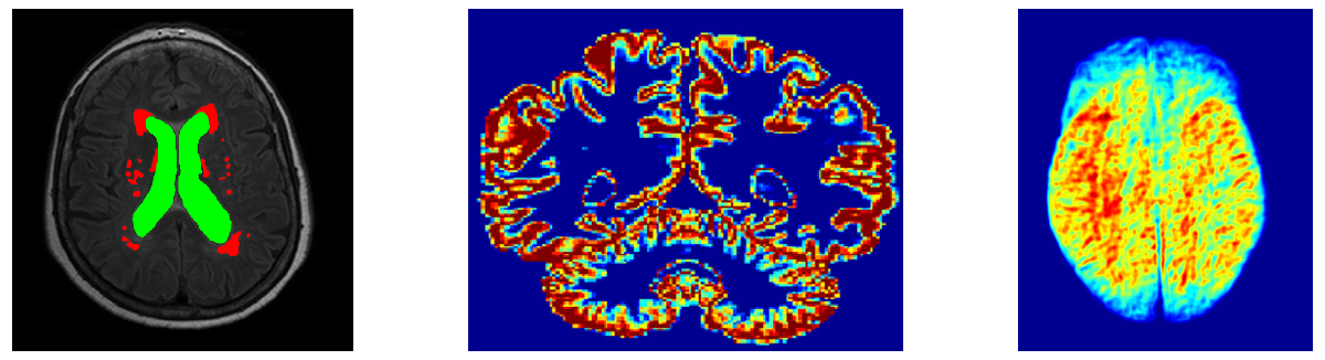 Collage of graphics that illustrate Image Analysis & Machine Learning for Neurological MRI