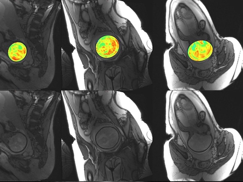 Gestational and Fetal MRI Technique Development and Clinical Applications