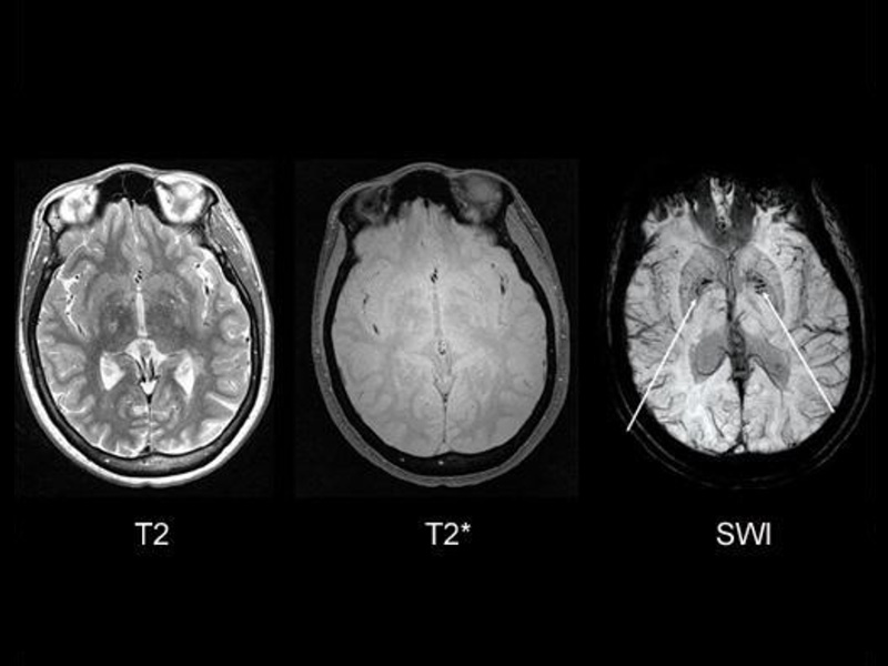 Menstrual Anaemia Detection
