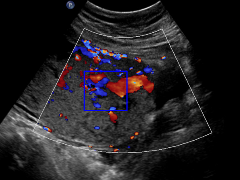 Invasive Placenta Identifcation and Classification