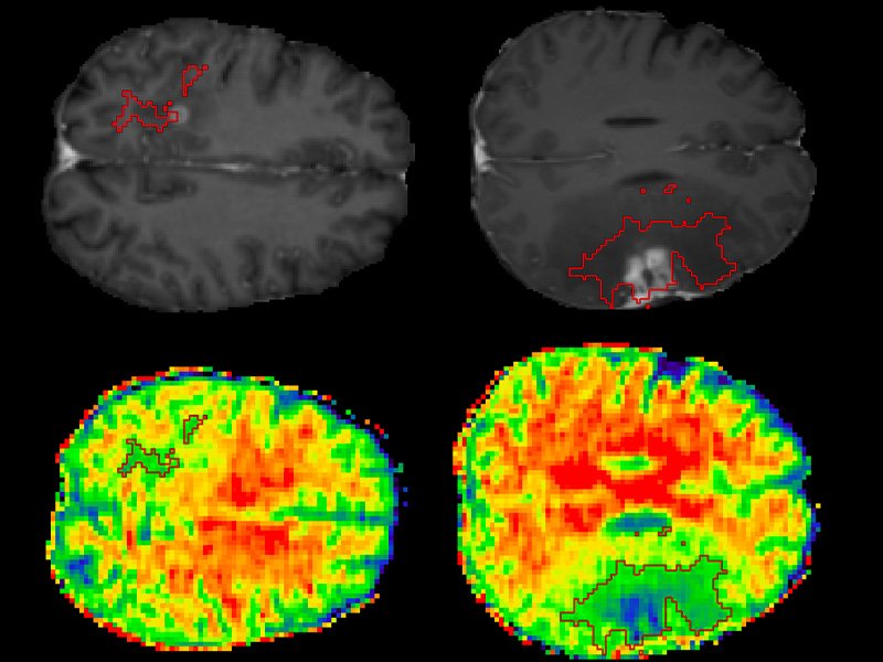 Smart Surveillance of Brain Tumors