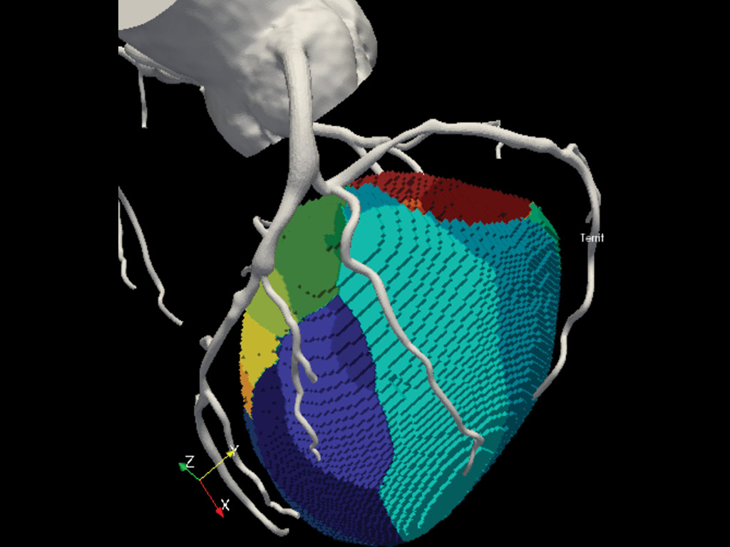 Territory mapping - step four in four-step process illustrating how Owais Khan develops a 3D computer model of patients’ hearts