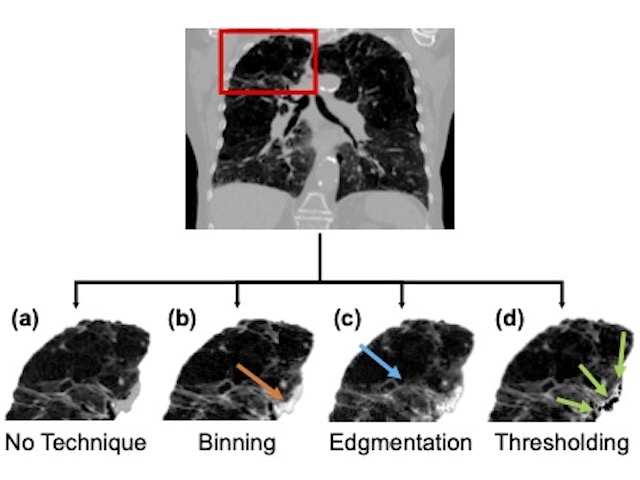 Black and white CT scan of lungs. Four smaller scans below, showing results of pre-processing techniques.