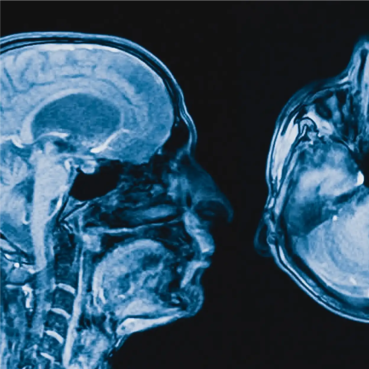 Close up side profile x-ray image of a skull beside another x-ray cut-off image.