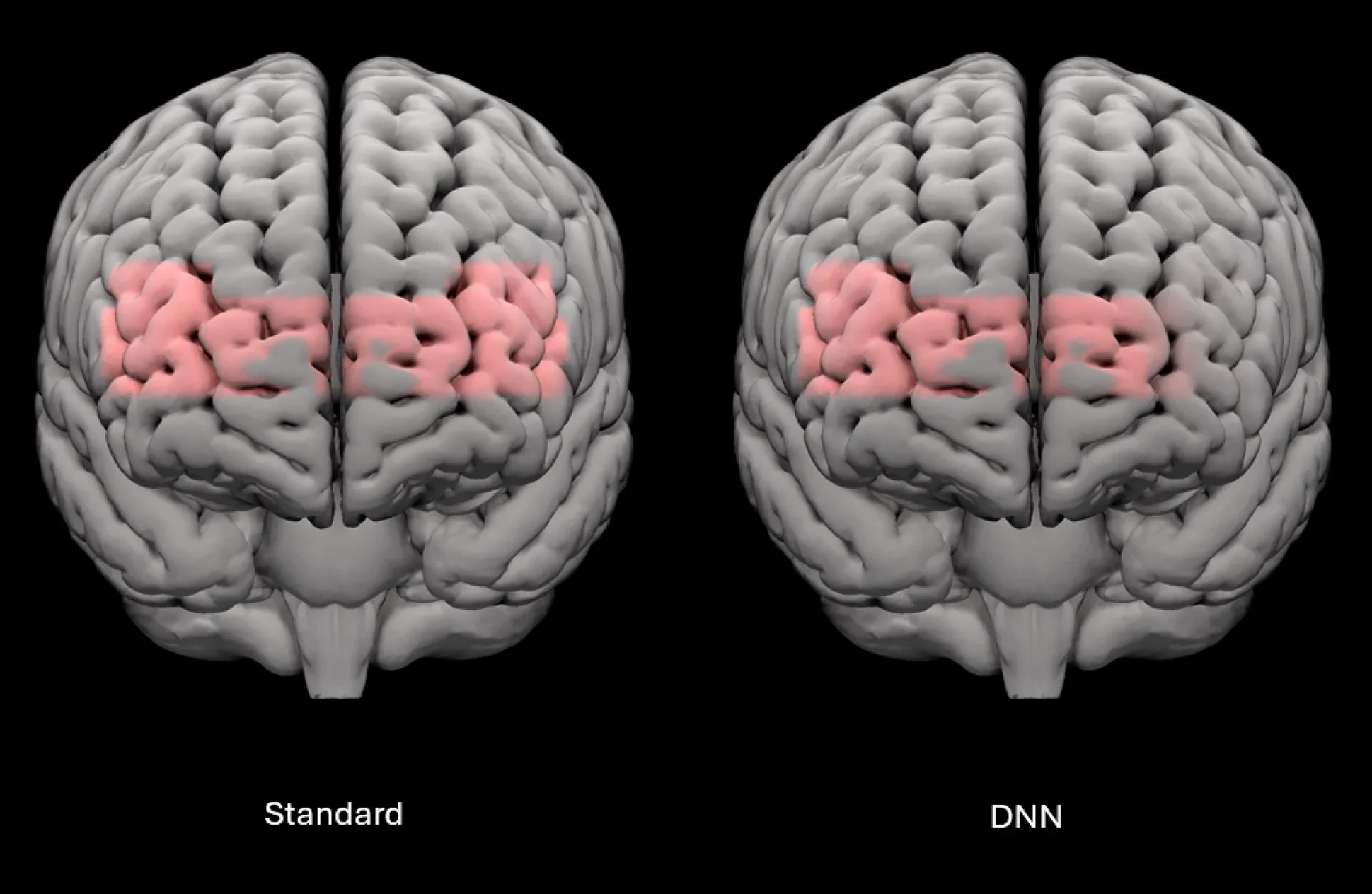 Side-by-side 3D brain images labelled “Standard” (left) and “DNN” (right) show pink-highlighted frontal regions of activity during speech-in-noise tasks