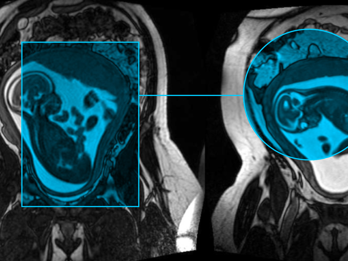 MRI images of two in-utero fetuses.