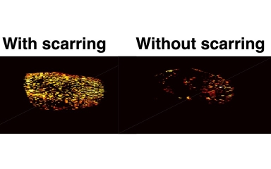 Photoacoustic maps of the degree of scarring within the kidney