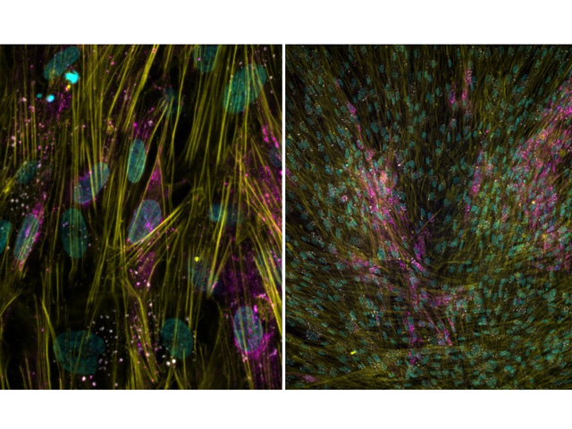 Magnified MRC-5 human lung fibroblast cells infected with human coronavirus.