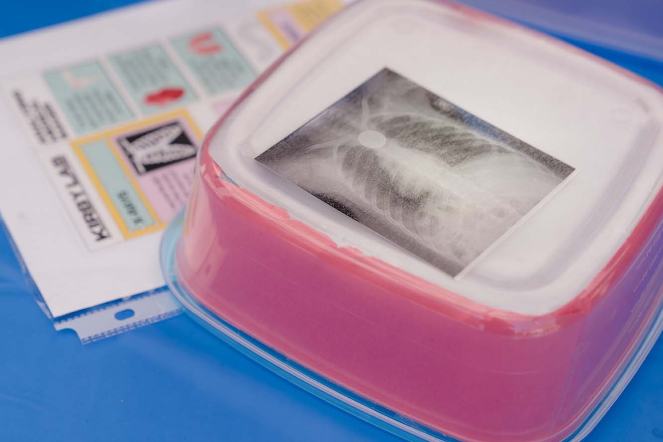 A lung X-ray on top of a pink lightbox and an information sheet about lungs on a table with a blue tablecloth.