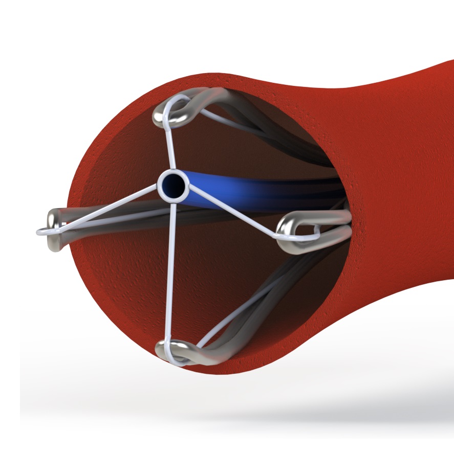 Expandable-Cable Driven Parallel Manipulator (X-CADPAM) concept within lumen